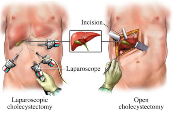 Лапароскопическая и открытая холецистэктомия