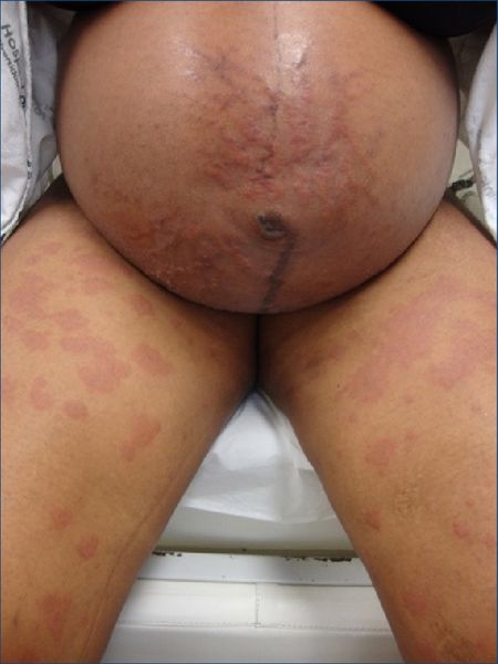 Полиморфная сыпь у беременной [20]