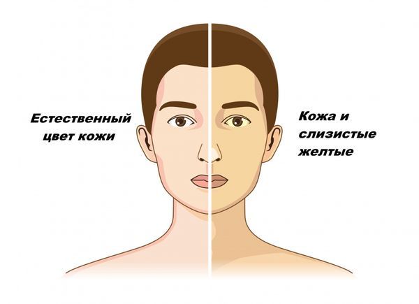 Признаки желтухи