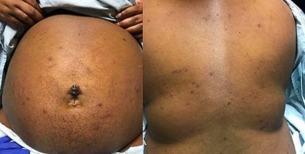 Зуд с ограниченными первичными поражениями кожи при холестазе беременных [19]