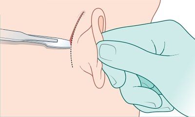 Хирургический доступ за ухом