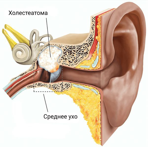 Холестеатома