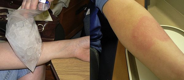 Провокационный тест [25]