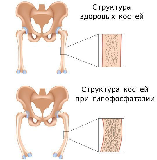 Кости при гипофосфатазии Кости при гипофосфатазии