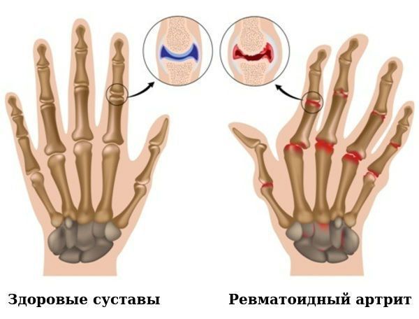 Поражение при ревматоидном артрите Поражение при ревматоидном артрите