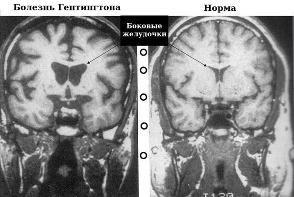 МРТ. Мозг при болезни Гентингтона и в норме.