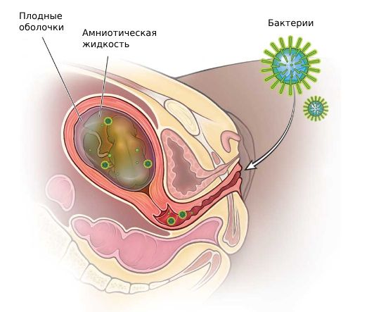 Хориоамнионит