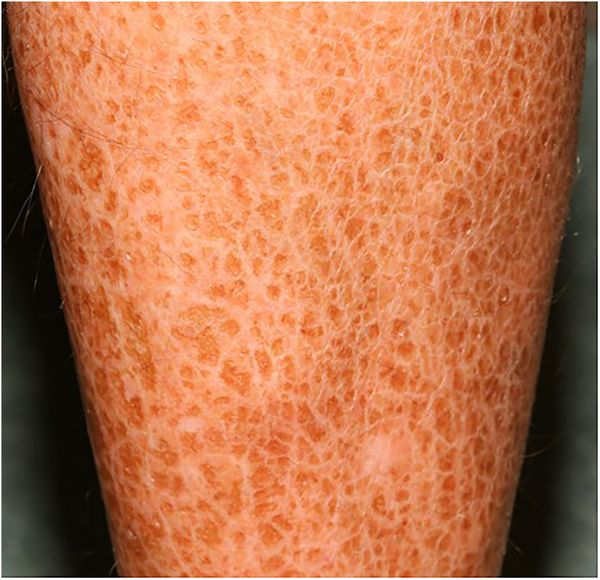 Кожа при вульгарном ихтиозе [27]