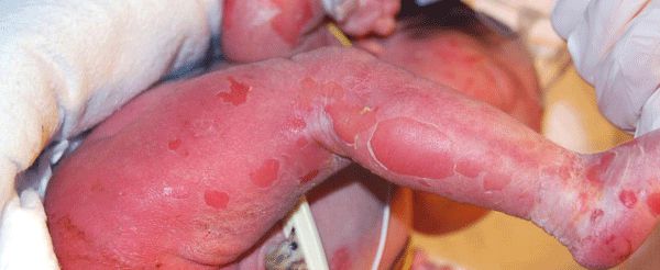 Врождённая буллёзная ихтиозиформная эритродермия [22]