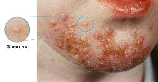 Фликтена [17]