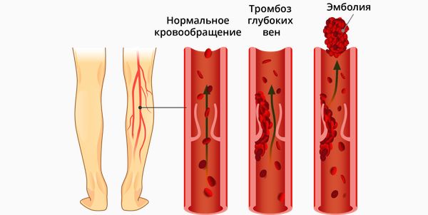 Тромб и эмбол в венах ног