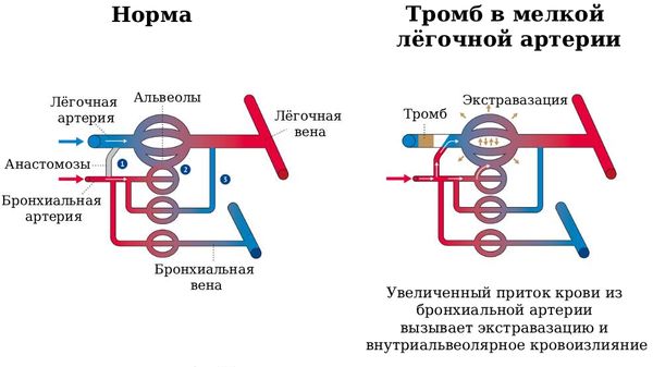 Тромб в мелкой лёгочной артерии [1]