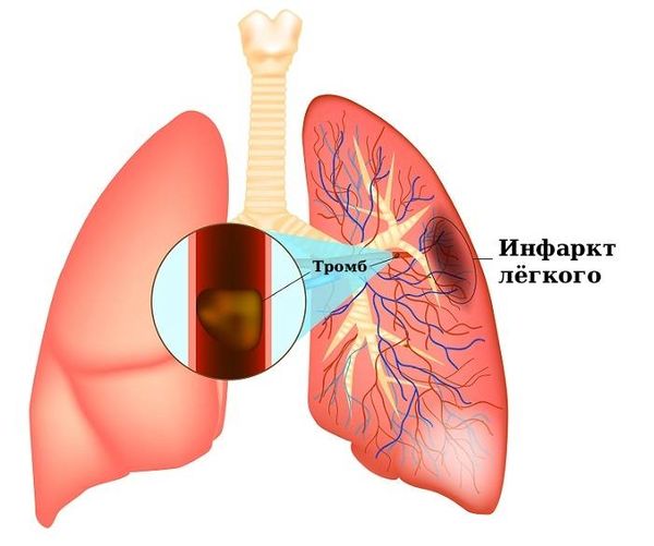 Закупорка ветви лёгочной артерии тромбом и инфаркт лёгкого Закупорка ветви лёгочной артерии тромбом и инфаркт лёгкого