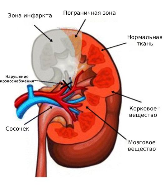 Инфаркт почки [5]