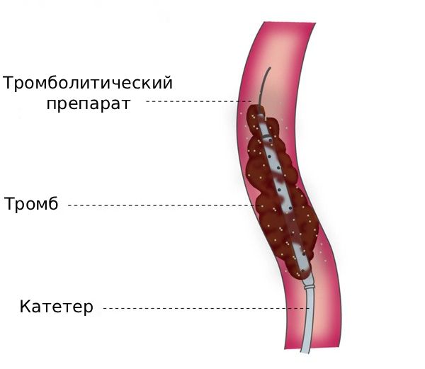 Катетер-направленный тромболизис