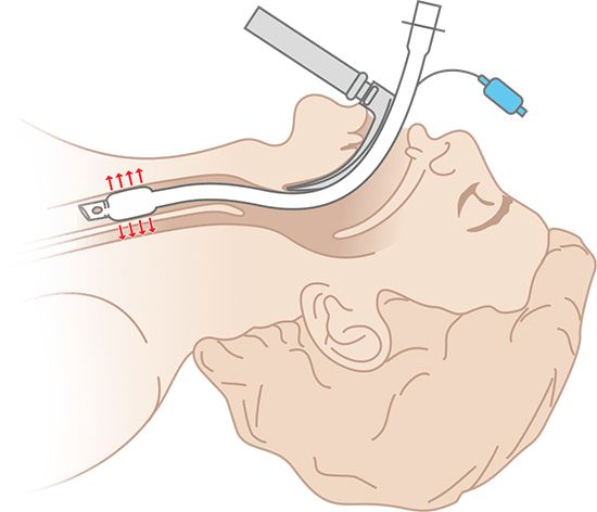 Интубация трахеи
