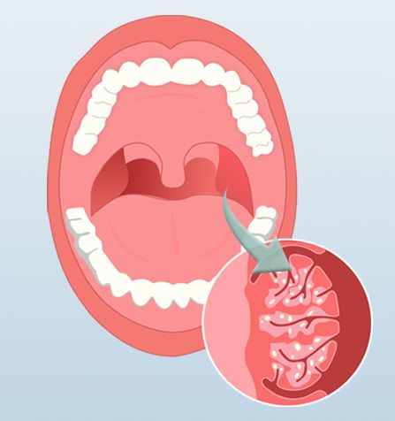 Лакуна в нёбной миндалине