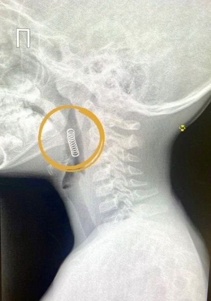 Пружина в глотке у ребёнка [30]