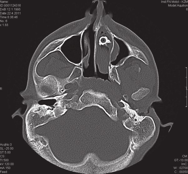 Инородное тело в полости носа на рентгенографии [16]