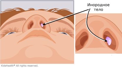 Инородное тело в носу: первая помощь ребенку