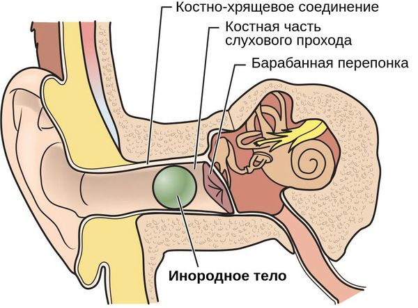 Инородный предмет в слуховом проходе