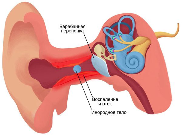 Воспаление и отёк наружного слухового прохода
