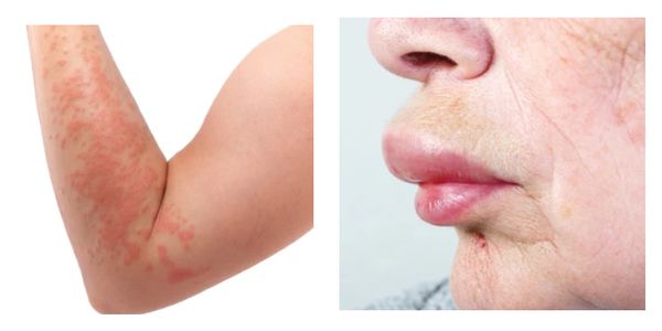 Распространённая крапивница и отёк губы [18]
