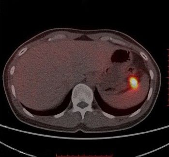 Выявление инсулиномы в поджелудочной железе при 68Ga-DOTA-exendin-4 ПЭТ/КТ [18]