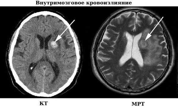 Внутримозговое кровоизлияние на КТ и МРТ [12]