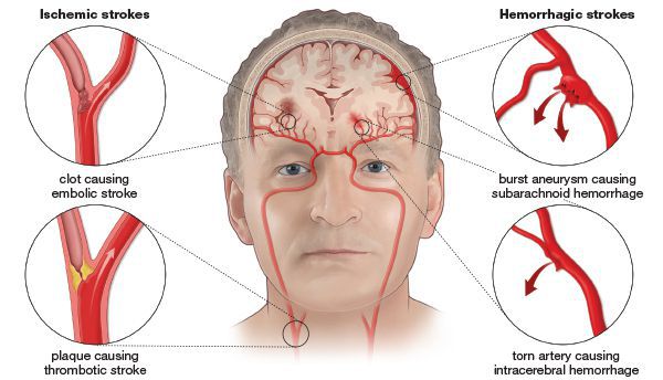Инсульт мозжечка: какие последствия и какие пути к выздоровлению?