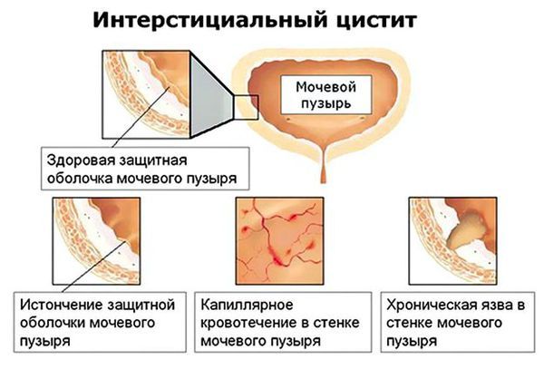Формы интерстициального цистита