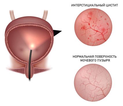 Интерстициальный цистит Интерстициальный цистит