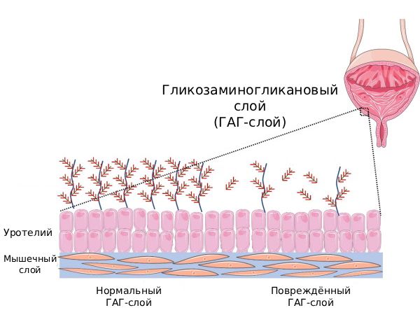 Повреждение гликозаминогликанового слоя