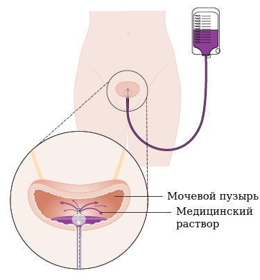 Внутрипузырная инстилляция Внутрипузырная инстилляция