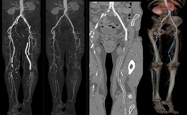Серия снимков пациента с выраженным поражением артерий конечностей
