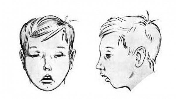 Аденоидный тип лица