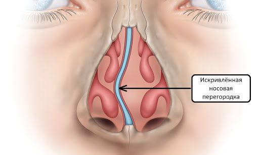 Деформация носовой перегородки