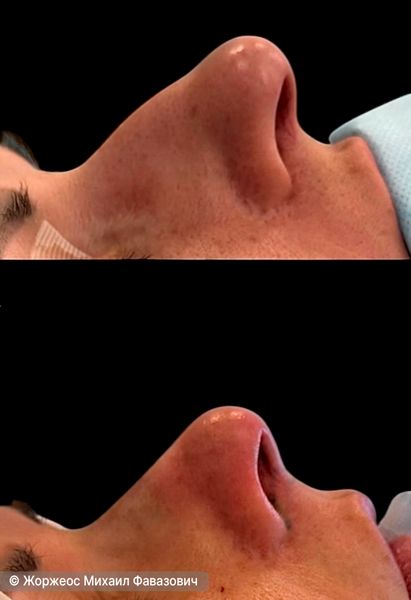 Ринопластика с коррекцией горбинки носа