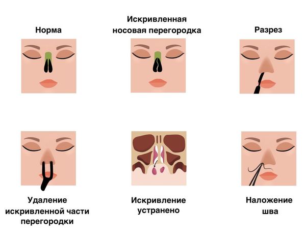 Септопластика