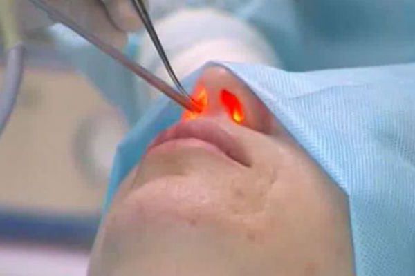 Лазерная коррекция перегородки носа