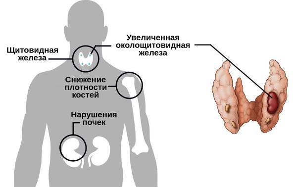 Гиперпаратиреоз