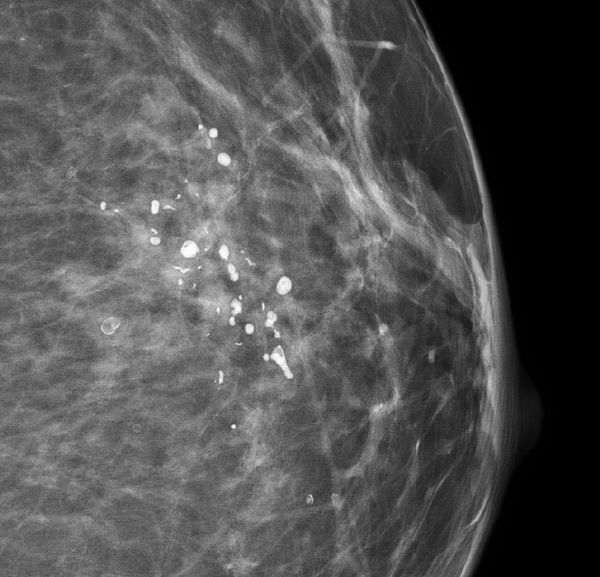 Дистрофические кальцинаты при жировом некрозе после операции [18]