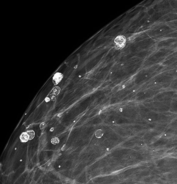 Кальцинаты в виде яичной скорлупы при жировом некрозе [18]