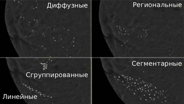 Типы кальцинатов по распространённости [17]