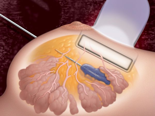 Забор материала из поражённого участка молочной железы Забор материала из поражённого участка молочной железы