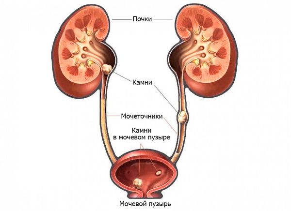 Диагностика камней почки мочеточника