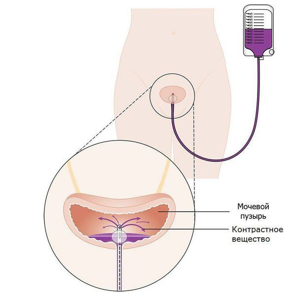 Цистография