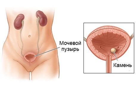 Цистолитиаз