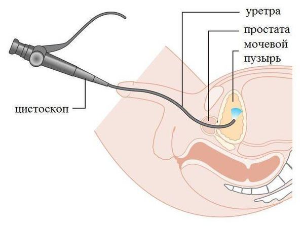 Цистоскопия