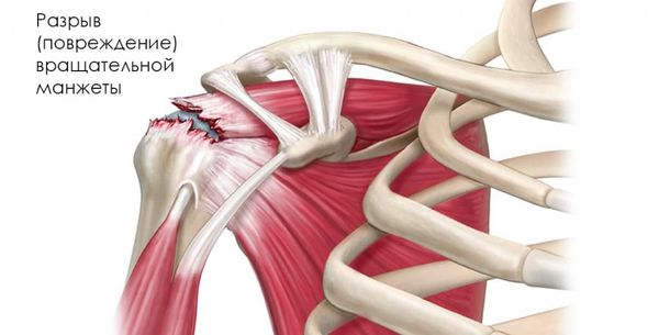 Повреждение ротарной манжеты